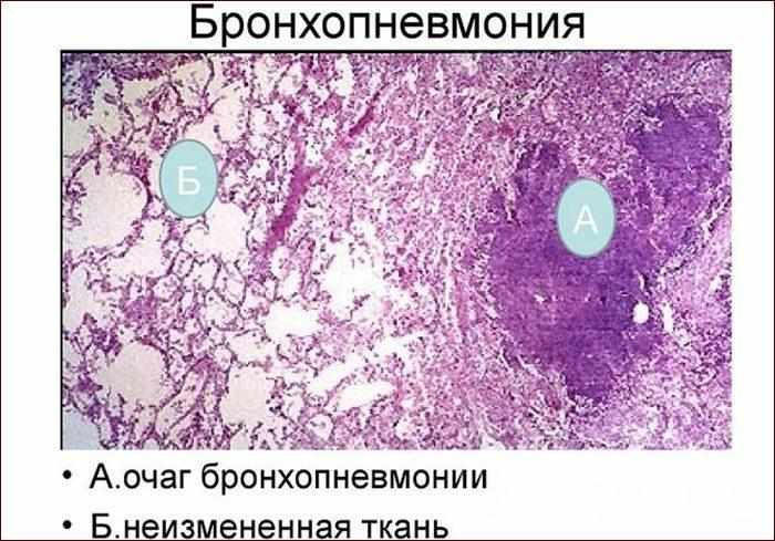 Очаги бронхопневмонии