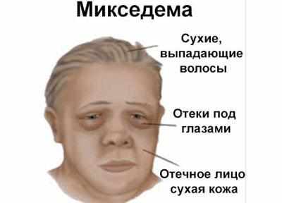 Симптомы микседемы