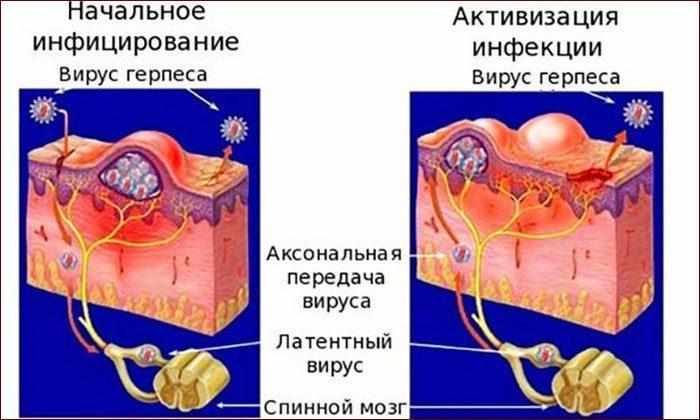 Заражение вирусом герпеса