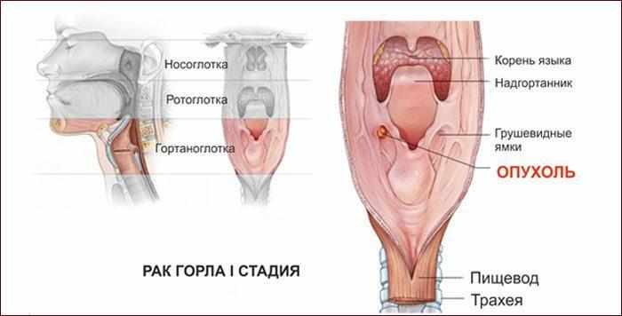Первая стадия рака гортани