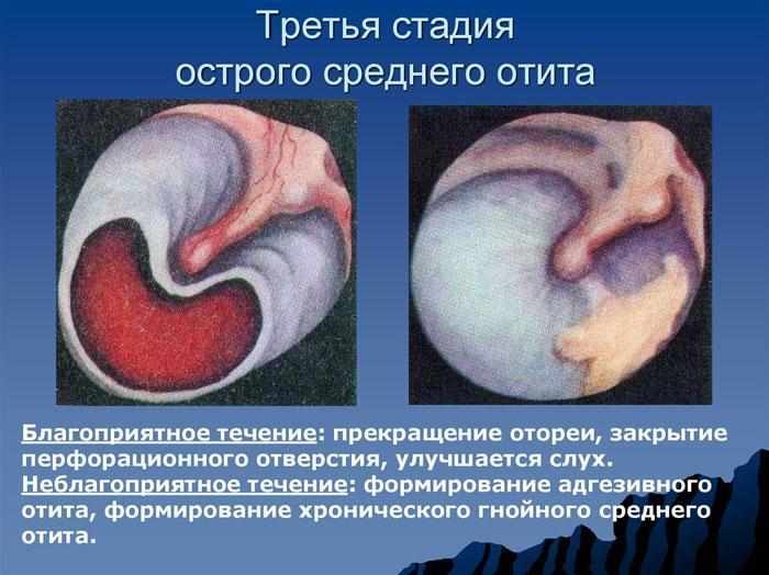 Третья стадия острого среднего отита