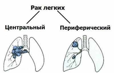Виды рака легкого