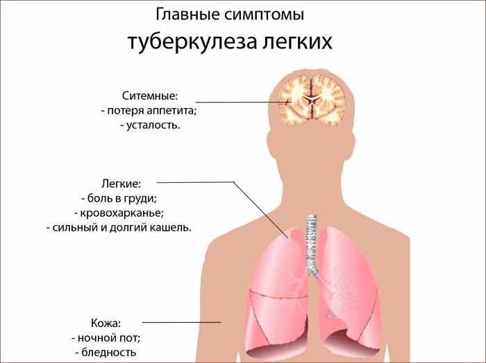 симптомы туберкулёза