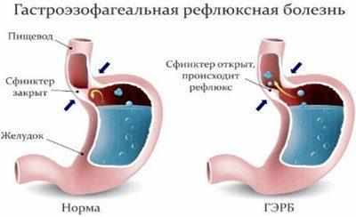 Гастроэзофагеальная рефлюксная болезнь