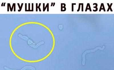 Мушки в глазах