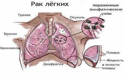 Рак легкого