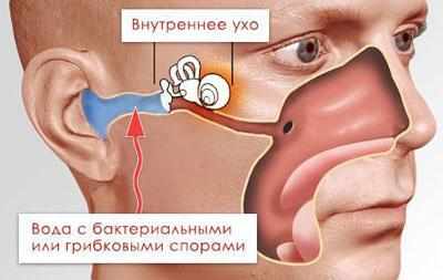 Следствие грибкового заболевания уха