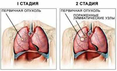 Стадии рака легкого
