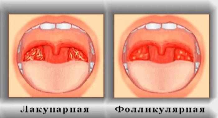 Фолликулярная и лакунарная ангины