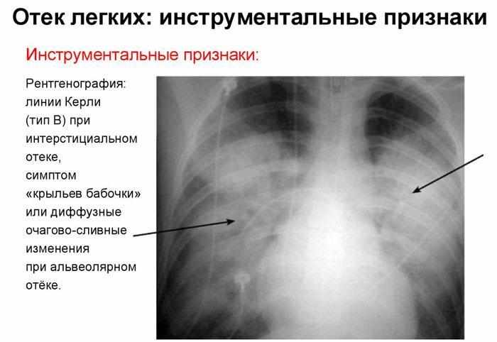 Отёк лёгких на рентгенограмме 
