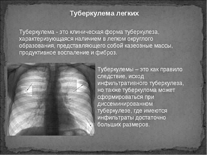 Туберкулёма лёгких