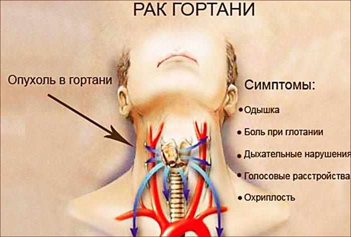 Симптомы рака гортани