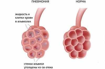 Альвеолы при пневмонии