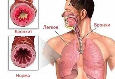 Проявление бронхита