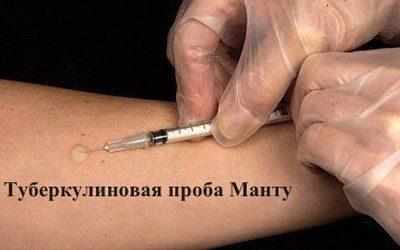 Туберкулиновая проба Манту