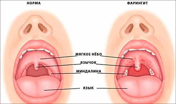Симптомы фарингита