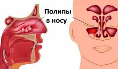 Полипы в носу
