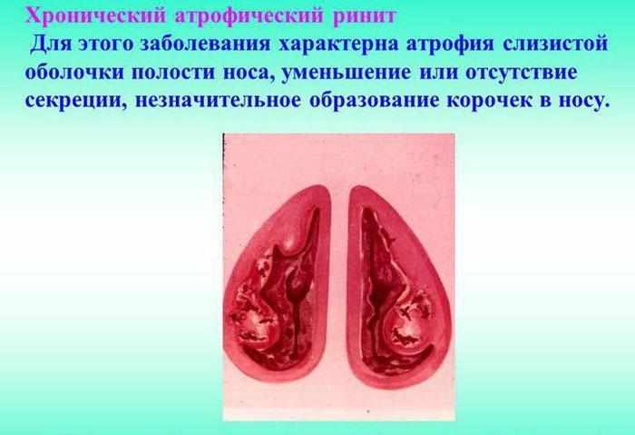Атрофический ринит