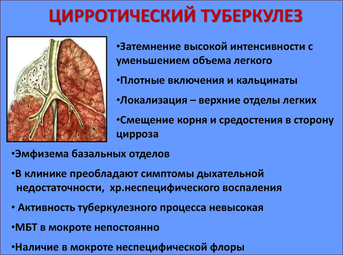 Что такое цирротический туберкулез легких