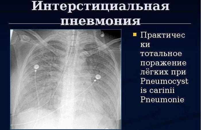 Интерстициальная пневмония на рентгене