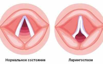 Проявление ларингоспазма