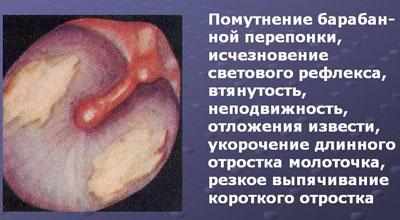Следствие адгезивного отита