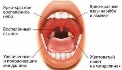 Горло при ветрянке
