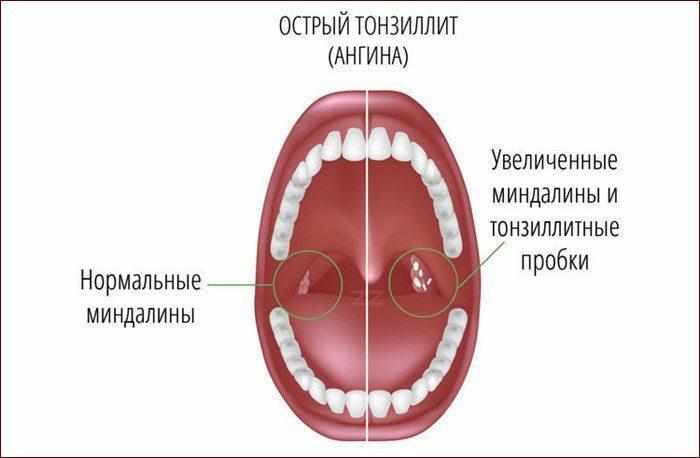 Горло при тонзиллите