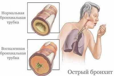Острый бронхит