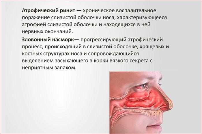 признаки атрофического ринита