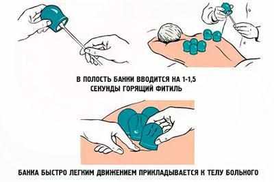 Правила лечения банками