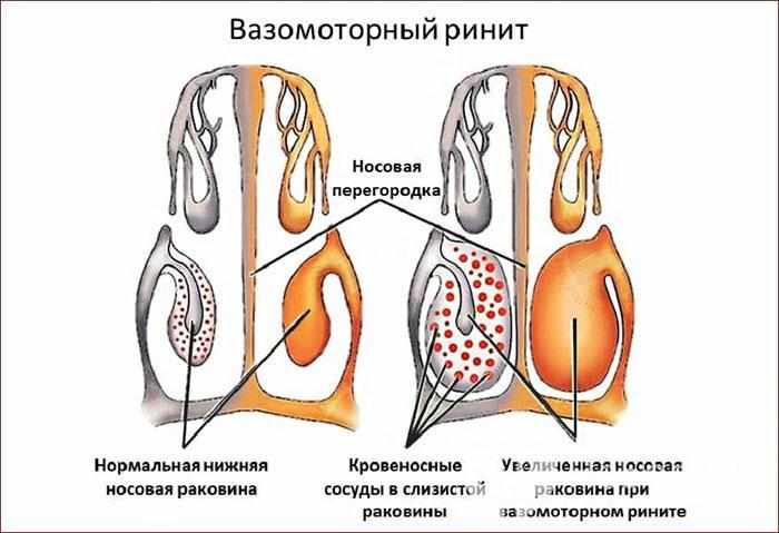 Симптомы вазомоторного ринита