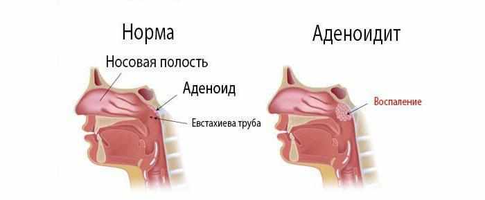 Аденоидит