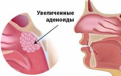 Увеличенные аденоиды