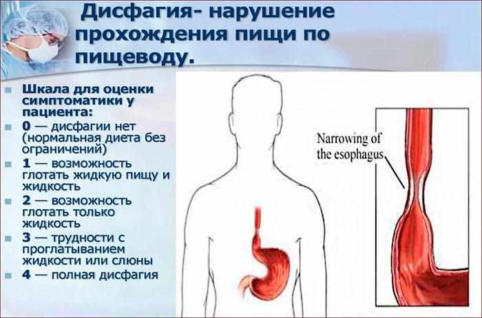 симптомы и степени дисфагии