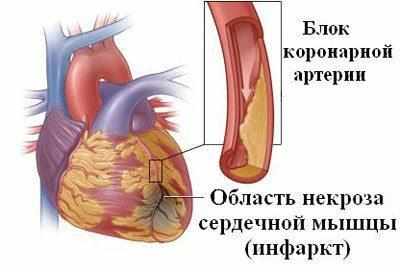 Инфаркт миокарда