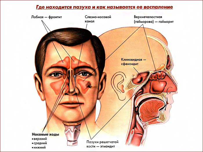 Локализация воспаления при фронтите, гайморите