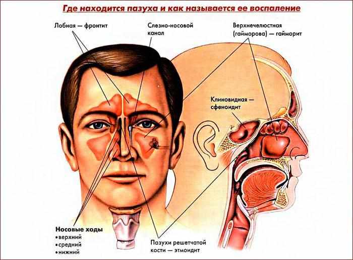 симптомы фронтита, гайморита