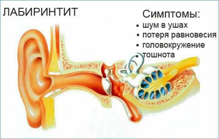 Симптомы лабиринтита