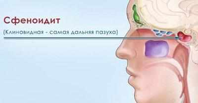Проявление сфеноидита