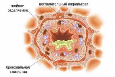 Проявление гнойного бронхита
