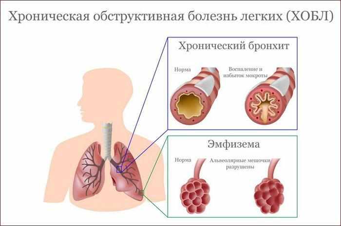 Признаки ХОБЛ