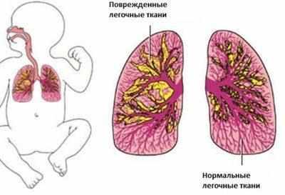 Бронхолегочная дисплазия