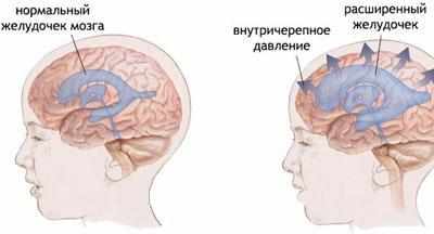 Повышение внутричерепного давления