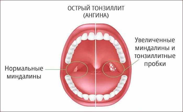 Симптомы острого тонзиллита
