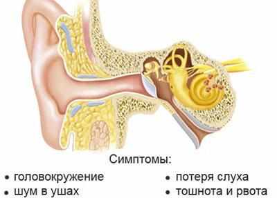 Симптомы болезни меньера