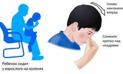 Помощь при носовом кровотечении
