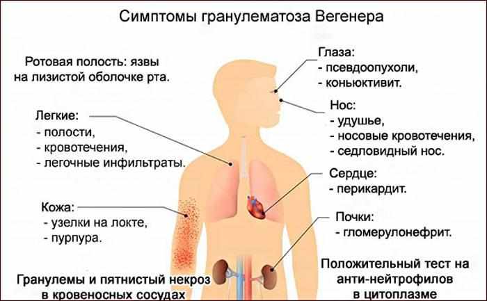 Симптомы гранумелатоза Вегенера.
