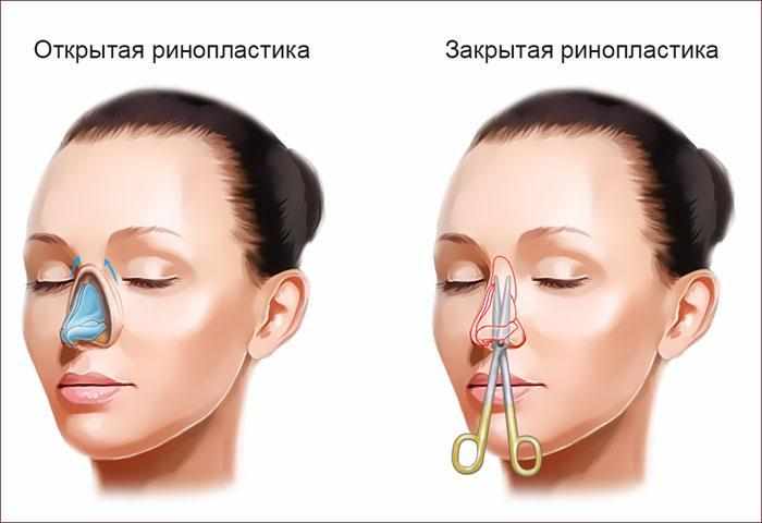 Открытая и закрытая ринопластика носа.