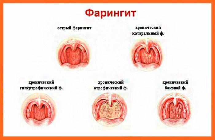 симптомы фарингита